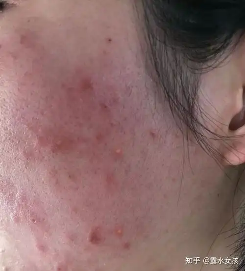 必须掌握的10个皮肤护理方法,让你用最少的钱搞定痘痘,黑头,敏感肌