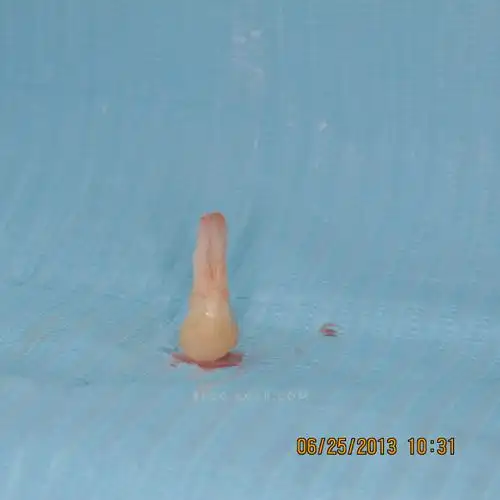 上颌第一双尖牙3牙根