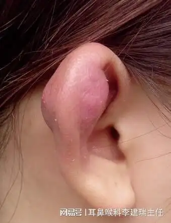 如果耽误病情,可能会造成化脓性耳廓软骨膜炎,最坏会造成耳廓畸形!