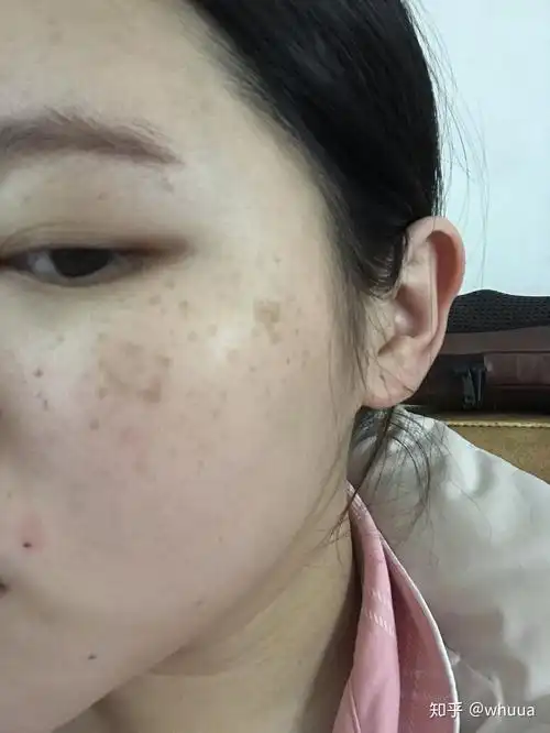 致长斑的姐们一点念想 - 知乎