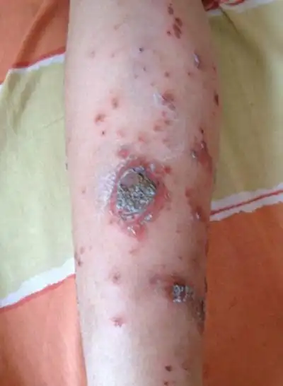 湿毒图片 (18)_有来医生