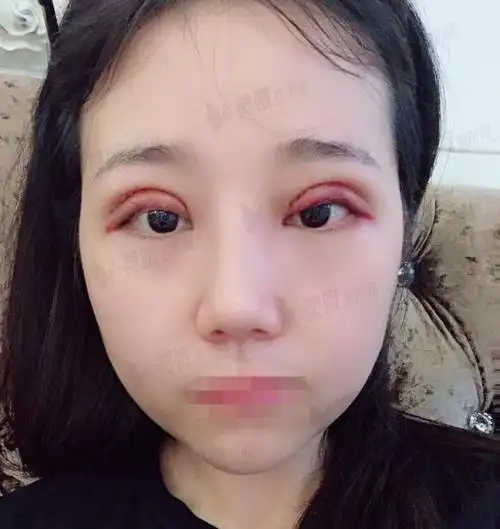 双眼埋线恢复七天图埋线双眼皮恢复过程记录及术后果参考