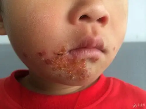 又见脓疱疮