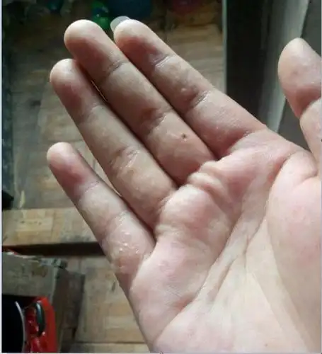 汗疱疹又称为出汗不良性湿疹,这是一种手掌,足跖部的水疱性疾病.