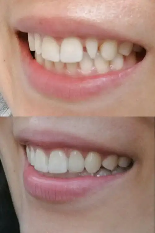 牙贴面也是要把牙齿磨小后贴上美容片吗?