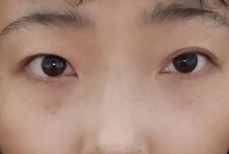 双眼皮贴  #新手化妆  #上睑提肌无力  #大小眼睛