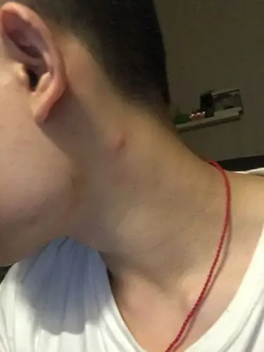 不碰没什么感觉,就像是一个青春痘一样的触感,本人有毛囊炎在后颈窝