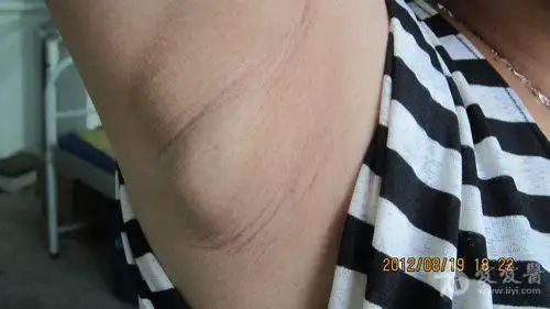 看图诊断右侧腋下包块1年