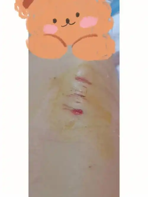 三四天就可以揭了,实在是太痒了,今天就揭了,大纱布里面有小创可贴