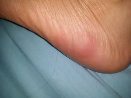 主要位于脚前掌,如图所示,一处大约4-5天可好.另一处又开始