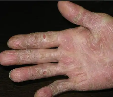 而角质层的细胞虽已是死细胞,但却是保护肌肤的重要屏障,可以防止外来