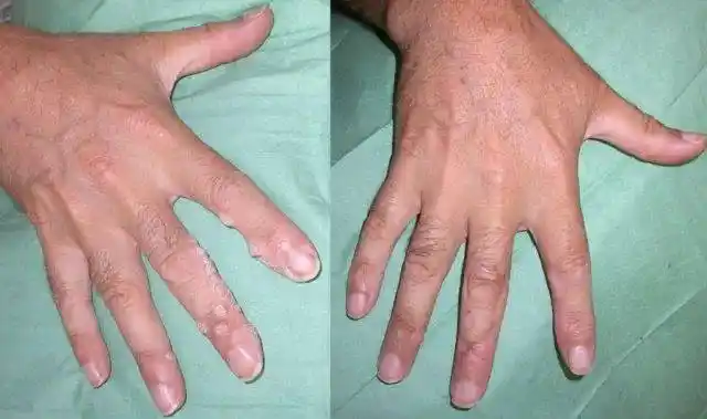 皮损内注射西多福韦顽固性疣的新选择