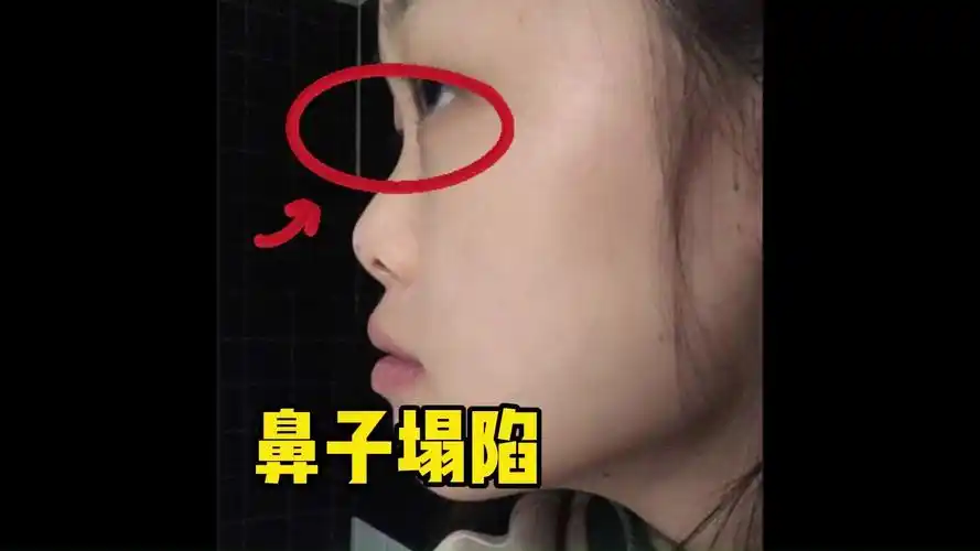 识人--鼻子塌陷