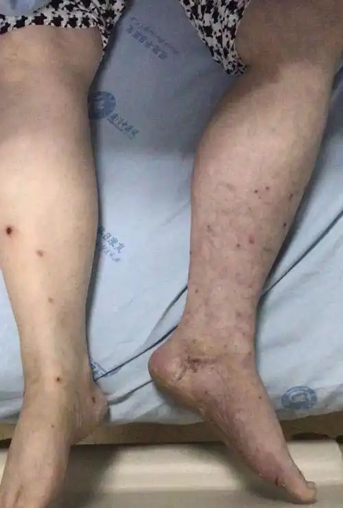 房颤擅自停药险截肢,微创介入取栓保住腿