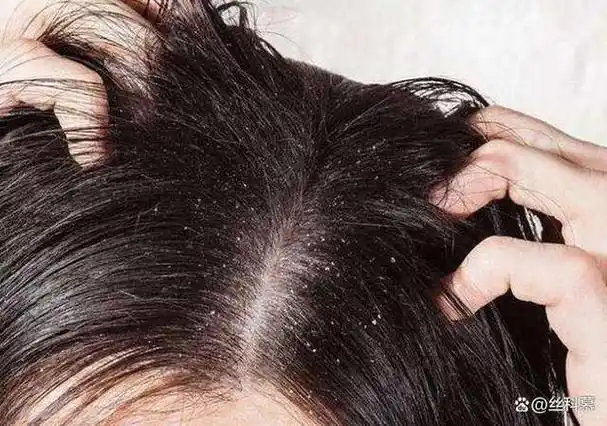 头发出油的原因主要是由于头皮的皮脂腺分泌了过多的油脂,导致头皮的