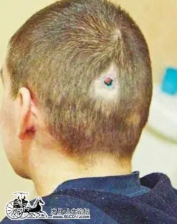 全世界头部中枪大难不死的人(组图)