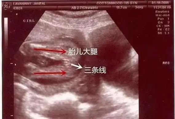 b超有两点基本是男孩(二)【看b超图】1,b超图上有"三条线"的标记,大
