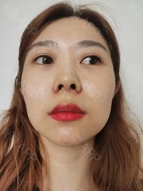 鼻翼缩小北京宫国华手术缩鼻翼术后1天