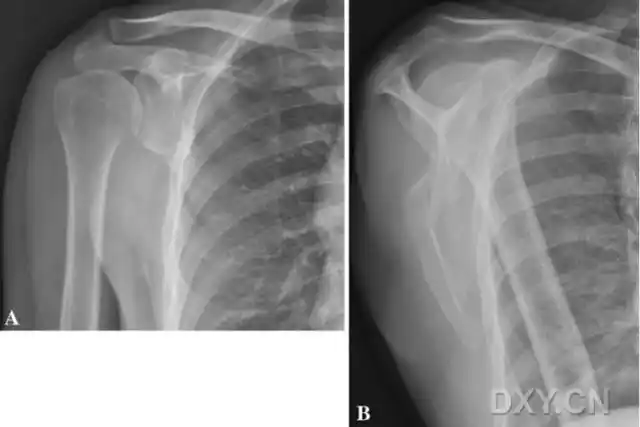 corr临床对照研究:移位性肩胛骨骨折的非手术与手术治疗效果相似
