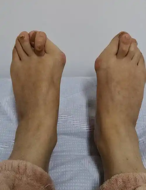 拇外翻越发严重了怎么办?大脚骨严重怎么手术_趾头_影响_发展