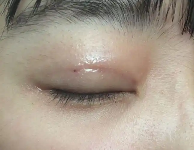 做完埋线双眼皮后眼尾倒数第二个点有个小黑点,还有点红肿,这个是线结