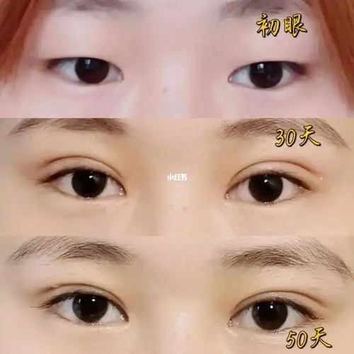 全切双眼皮恢复期对比