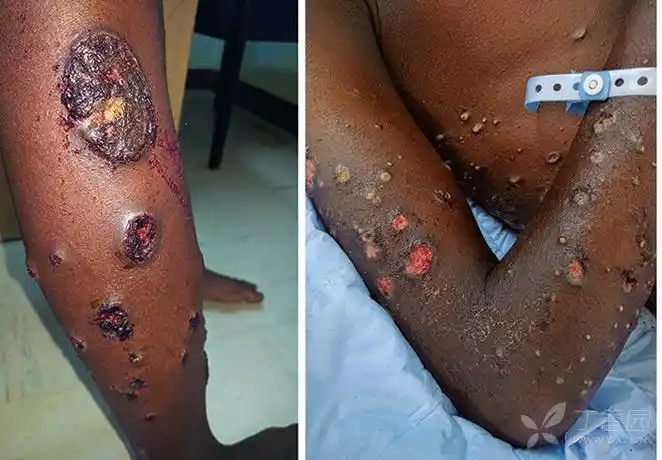 青年男性,身体多发出血斑块和脓疱2周,请你来分析 - 皮肤与性传播疾病