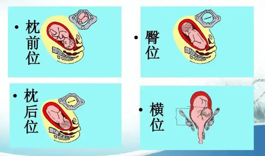 因素二:胎位情况胎儿在妈妈肚子里,可能横着,也可能竖着,还可能躺着