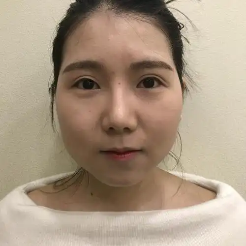 脸大可以做面部吸脂吗?