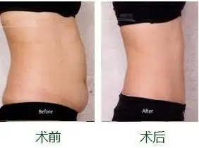 深圳整形 减肥塑身案例