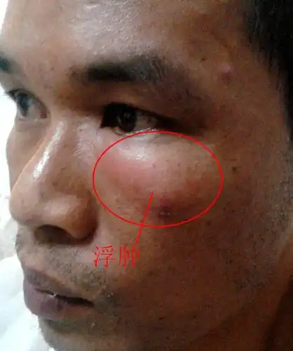 会呈现暂时性凹陷压痕,常见于肾炎(急,慢性肾炎),肾病综合症及心脏病