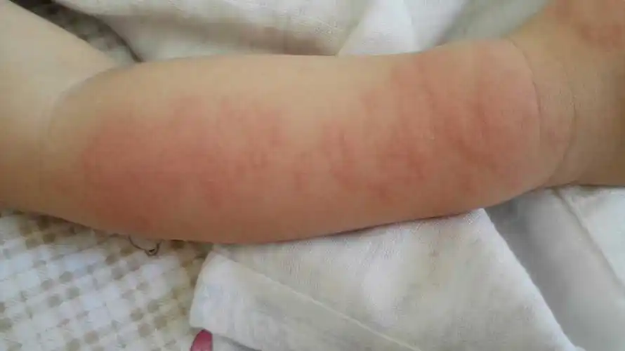 宝宝这两天过敏,皮肤长红色的一块块的东西,可是过几个小时自己就又