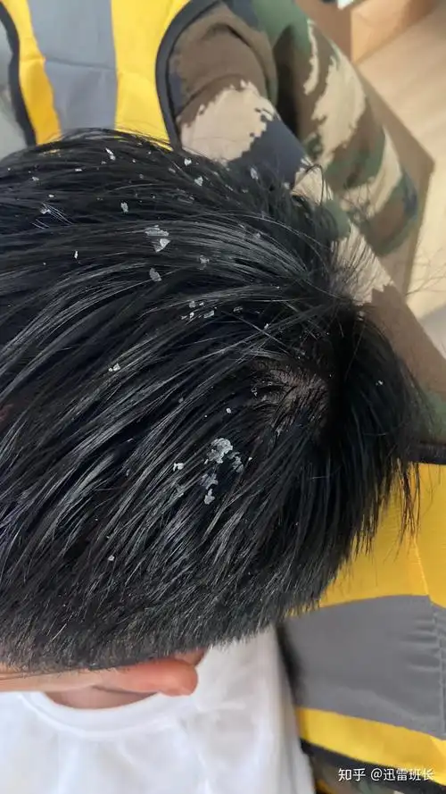 见过的最大头皮屑多大
