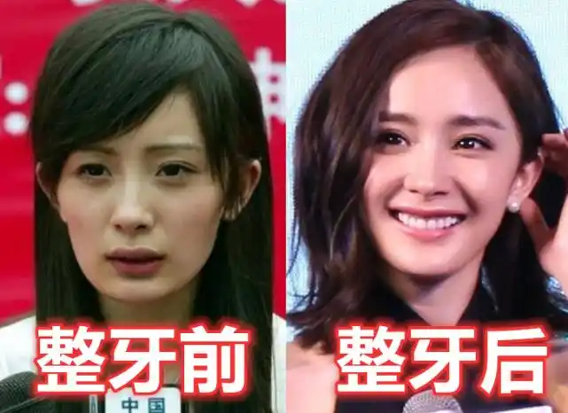有种差距叫"明星整牙",郑爽变美,杨幂气质,而她堪比"整容"