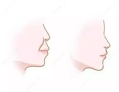 矫正的前后侧面对比图