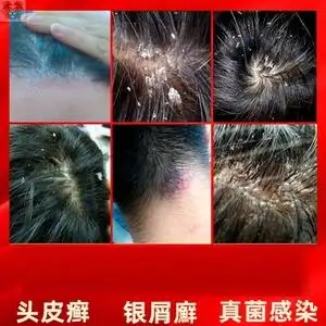 头癣银屑癣毛囊炎专用药头部外用头皮真菌克星抑菌乳膏皮囊炎药膏