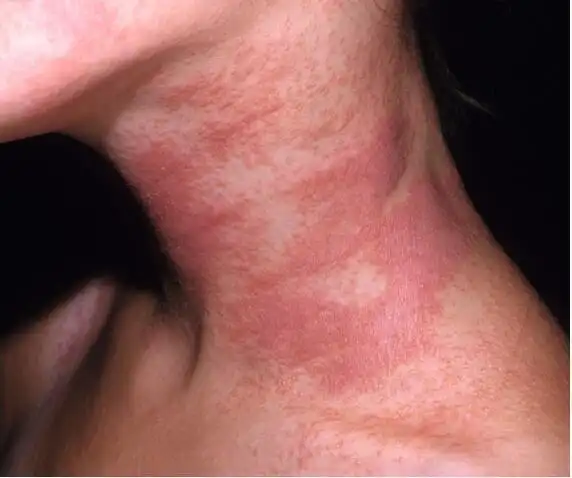 a为慢性湿疹皮肤增厚变厚;b为典型特应性皮炎的湿疹样表现屈侧皮肤