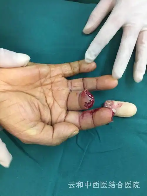 你的手指捡回来了吗?