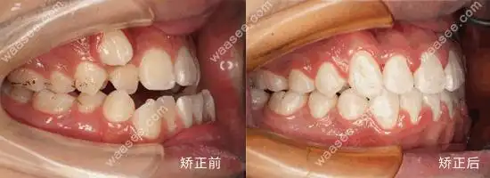 虎牙矫正两年后的效果.jpg