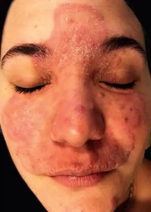 行医笔记盘点10种面部炎性皮肤病