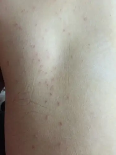 最近回国吃的比较辛辣油腻 而且有点水土不服我在北京你懂的 身上长了