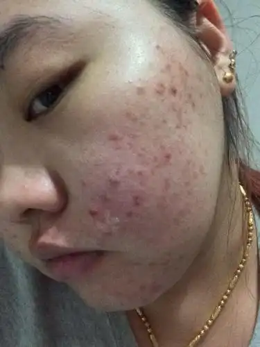 脸上涨了好多痘痘,去医院说是毛囊炎,吃了药也不管用,脸上总是红红的