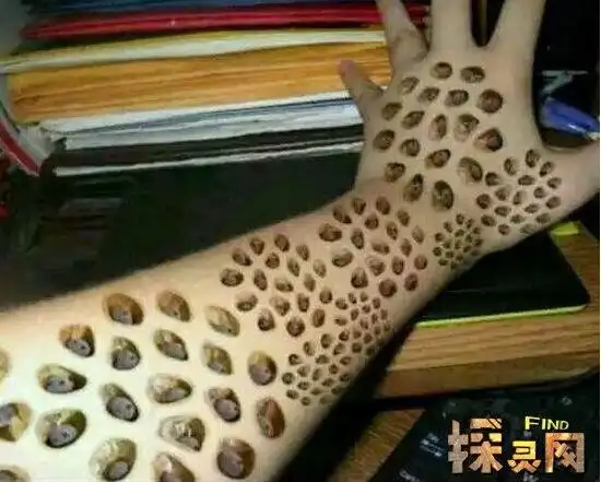 恶心的疾病,这种疾病名为蝇蛆病,会使女性的乳房发生病变,然后不断的