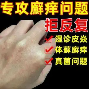 独家草本药膏鹅掌风苗家偏方药膏云南药膏背后去螨虫药膏外用皮肤