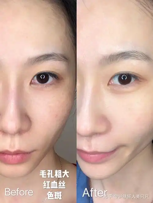 如今皮肤状态还不错,红血丝毛孔都得到了很明显的改善,陈年老痘印基本