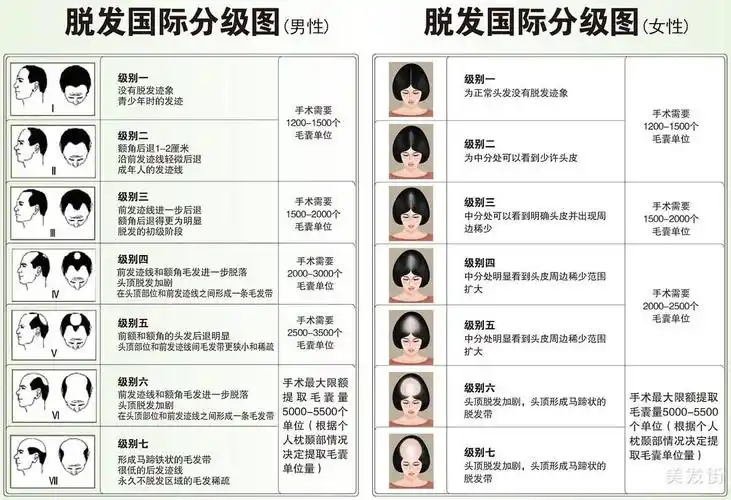 脱发的等级!