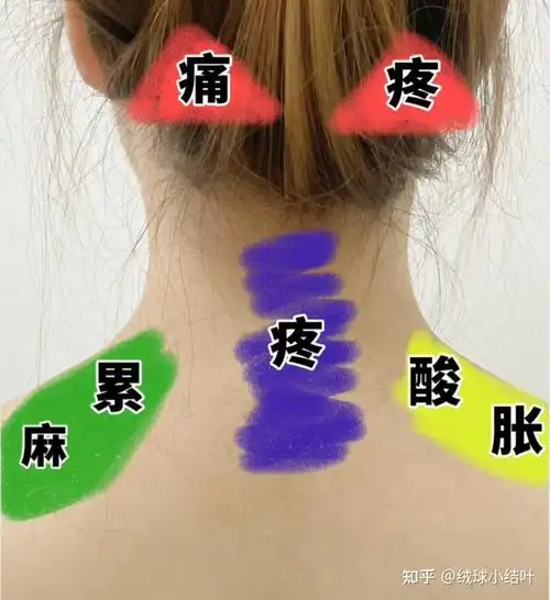 腰肌劳损/背部筋膜炎/背痛怎么判断和康复? - 知乎