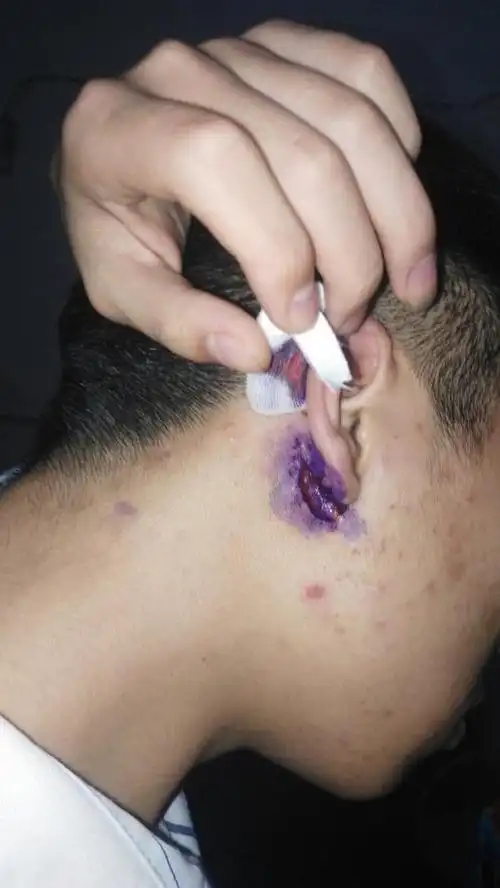 耳朵下面长了一个囊肿然后动了手术七天后拆了线,然后现在就跟图片一