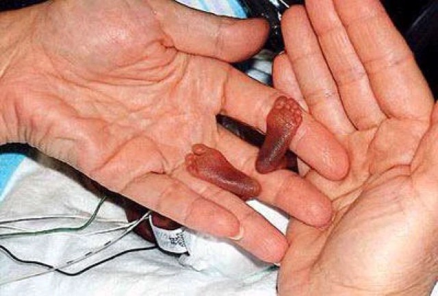 [惠州妈妈帮]有没有五个月引产的宝妈