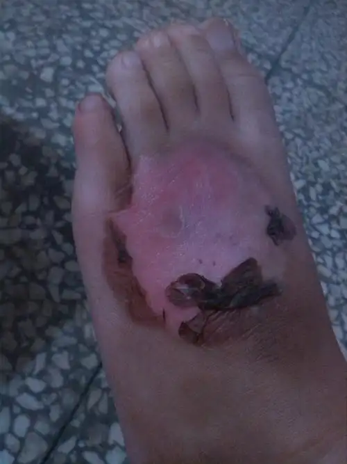 3岁小孩脚背2度烫伤,现在在长新表皮,大家帮我看看会不会流疤.